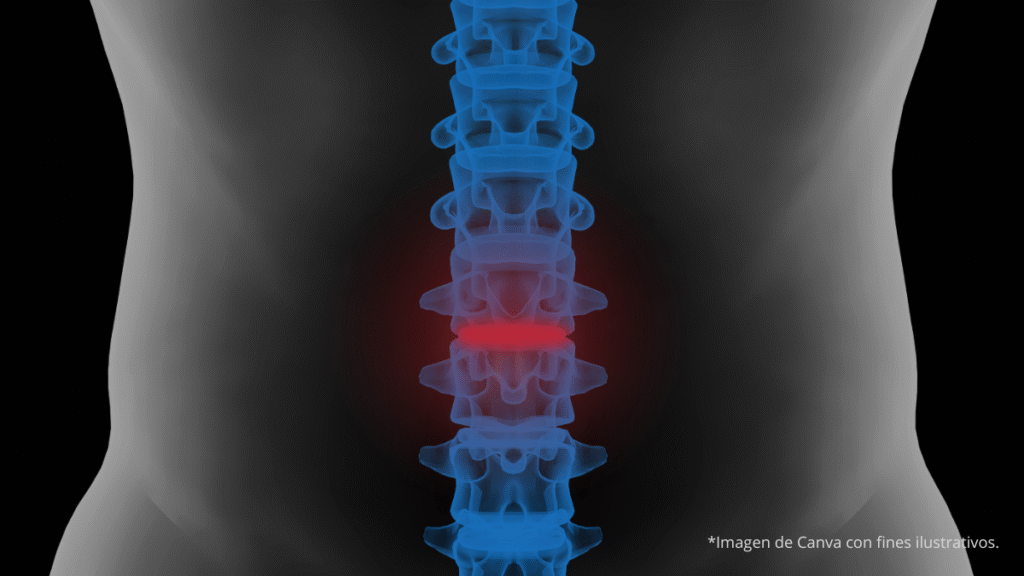 disco intervertebral